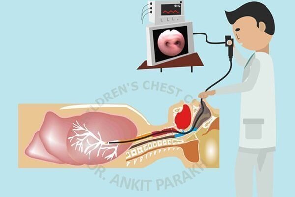 Flexible Bronchoscopy for Children