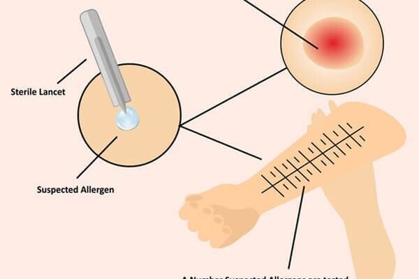 Skin Prick Test (Allergy Test)
