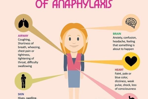 Anaphylaxis in Children