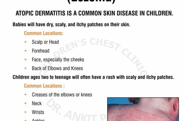 Atopic Dermatitis Eczema