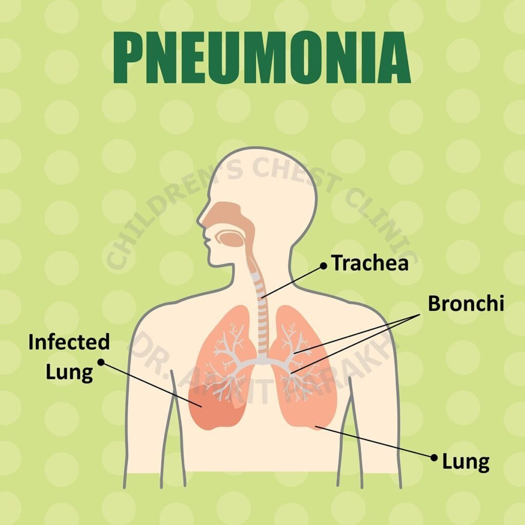 Pneumonia in children