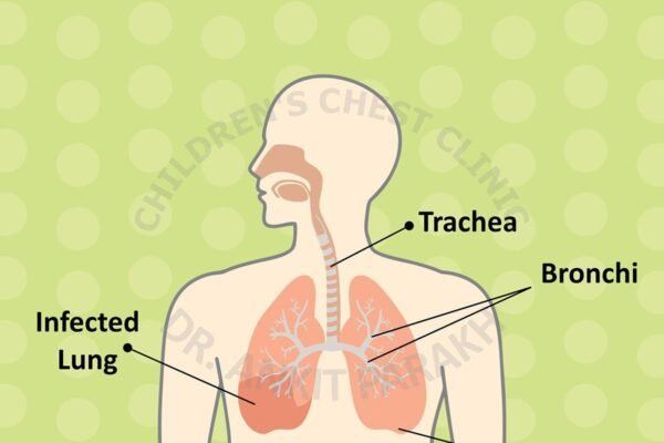 Pneumonia in children