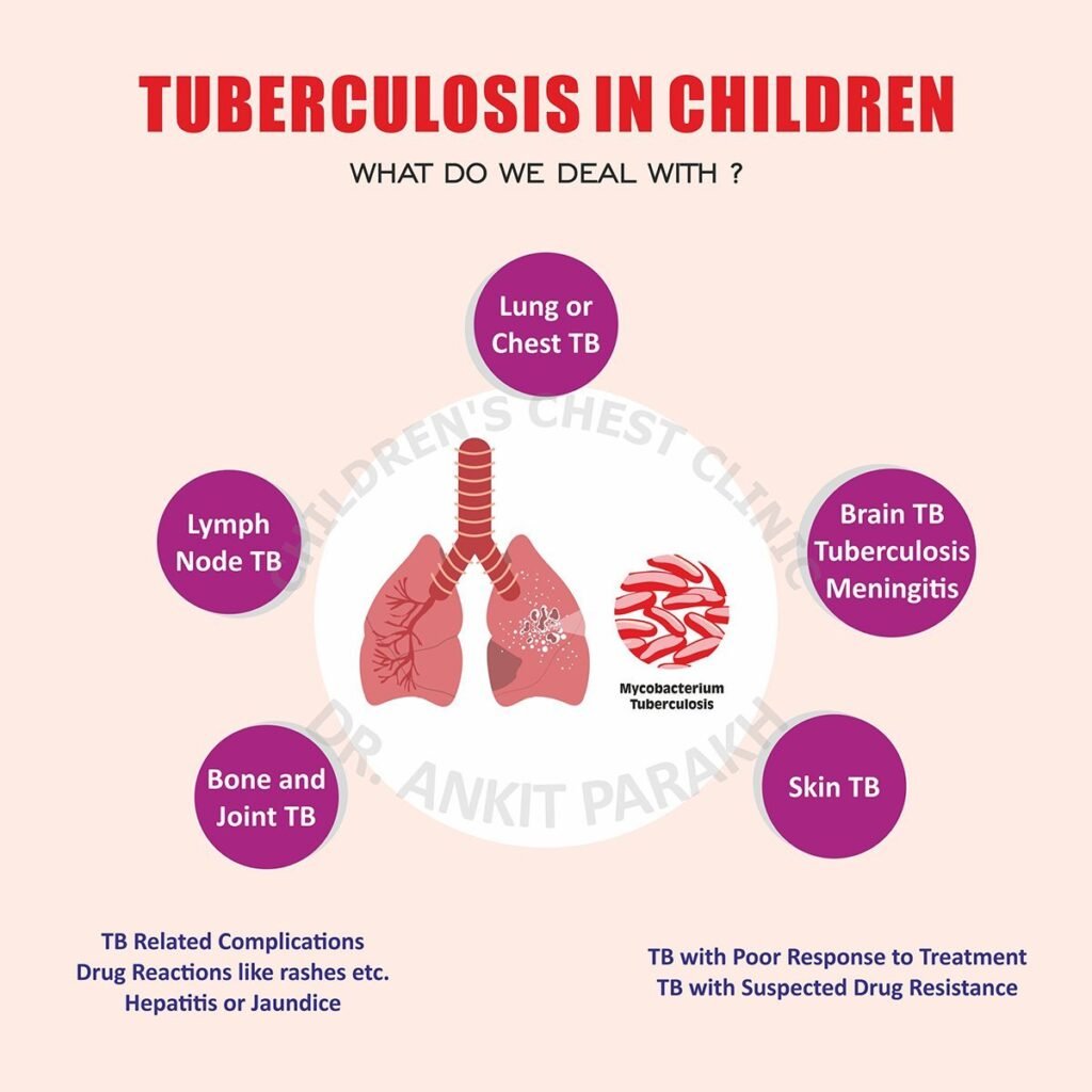 Tuberculosis (TB) in Children: What we deal with?