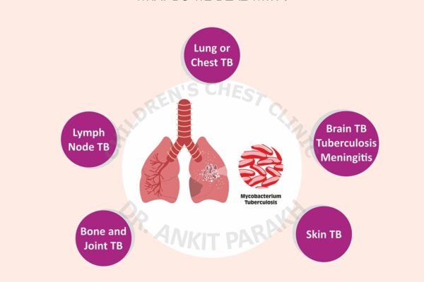 Tuberculosis (TB) in Children: What we deal with?