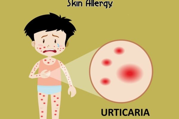 Itchy bumps on skin: Urticaria or hives in children