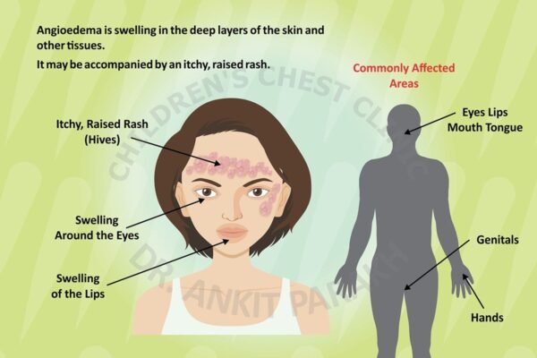 Angioedema in Children