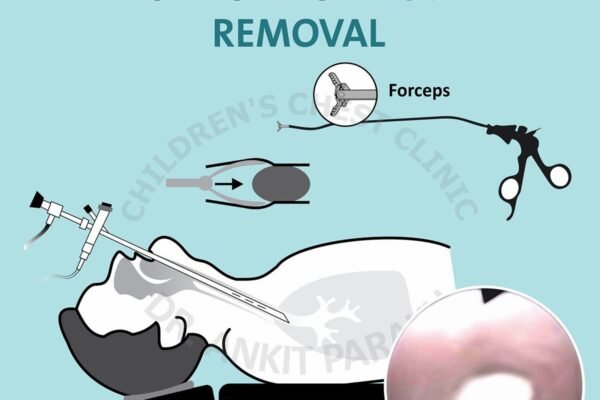 Rigid Bronchoscopy for Children