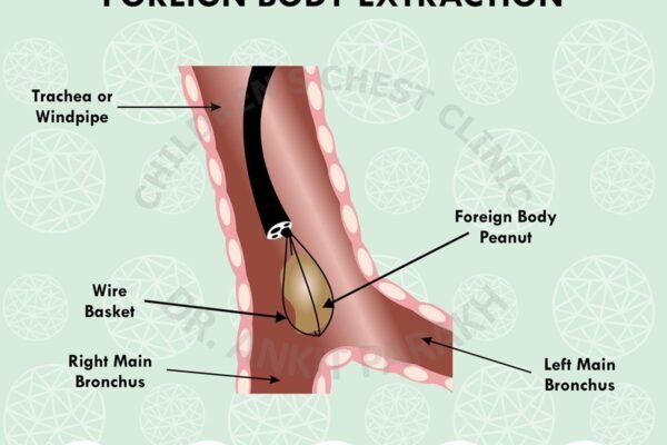 Flexible Bronchoscopy for Foreign Body Extraction