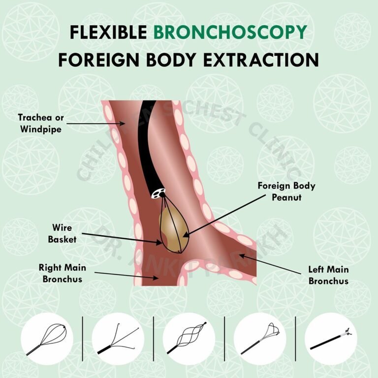 Flexible Bronchoscopy for Foreign Body Extraction