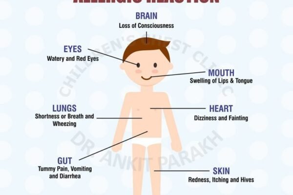 Common symptoms of allergy in children