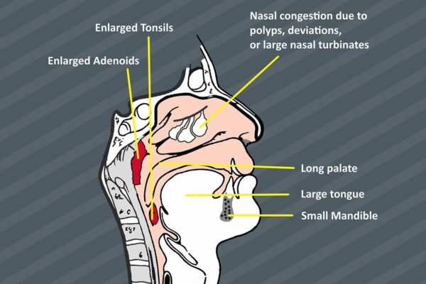 Snoring in children: When to worry?