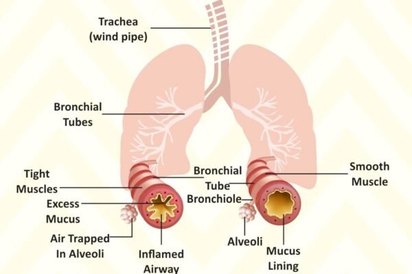 Asthma Attack in Children: Causes, Early Warning Signs, and Treatment