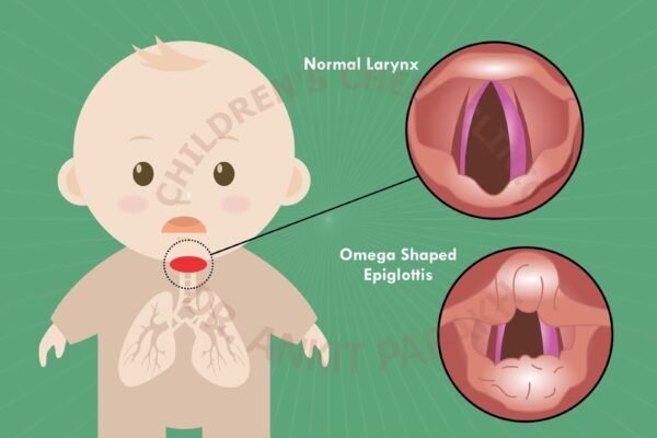 What is laryngomalacia?