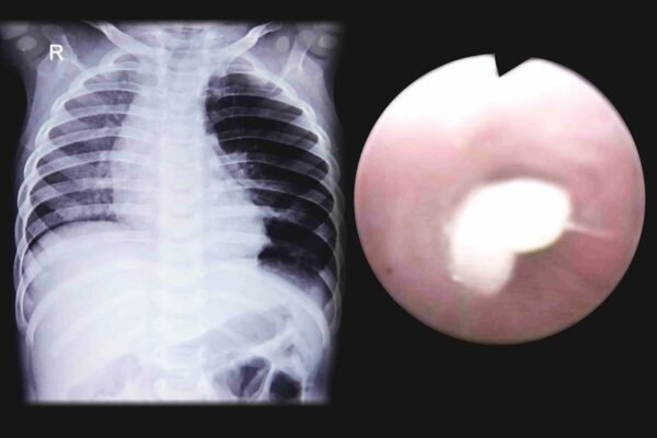 Foreign Body in Child’s Airway