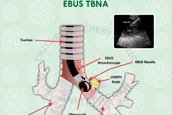 Endobronchial Ultrasound Guided Transbronchial Needle Aspiration