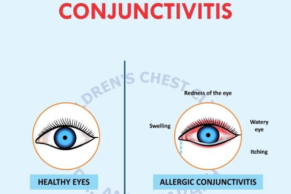 Allergic Conjunctivitis or Eye Allergy