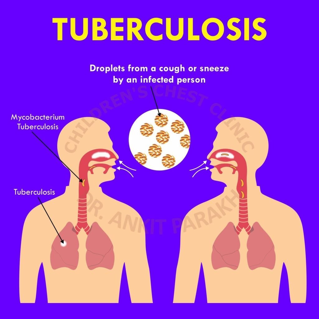 Tuberculosis: Spreads by Cough