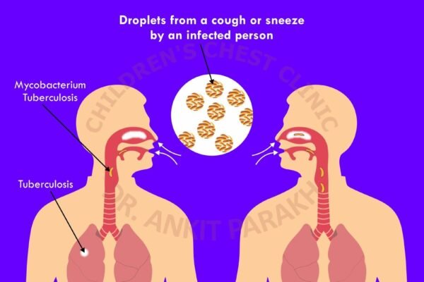 Tuberculosis: Spreads by Cough