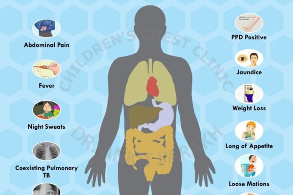 Abdominal Tuberculosis in Children