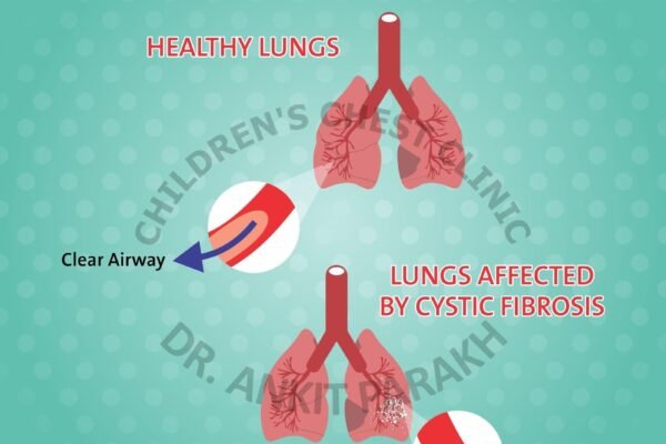 Lung problems in Cystic Fibrosis - symptoms and causes