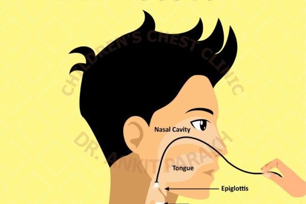 When is a Flexible Laryngoscopy required in children