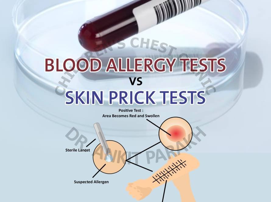 Skin Prick Test (SPT) vs Blood Allergy Tests
