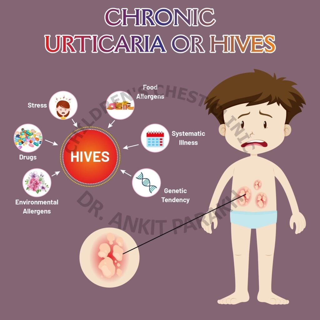 Chronic Urticaria or Hives: How to diagnose and treat