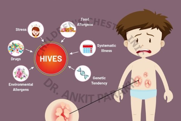 Chronic Urticaria or Hives: How to diagnose and treat