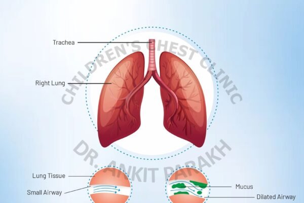 Bronchiectasis: Causes, Symptoms, and Diagnosis