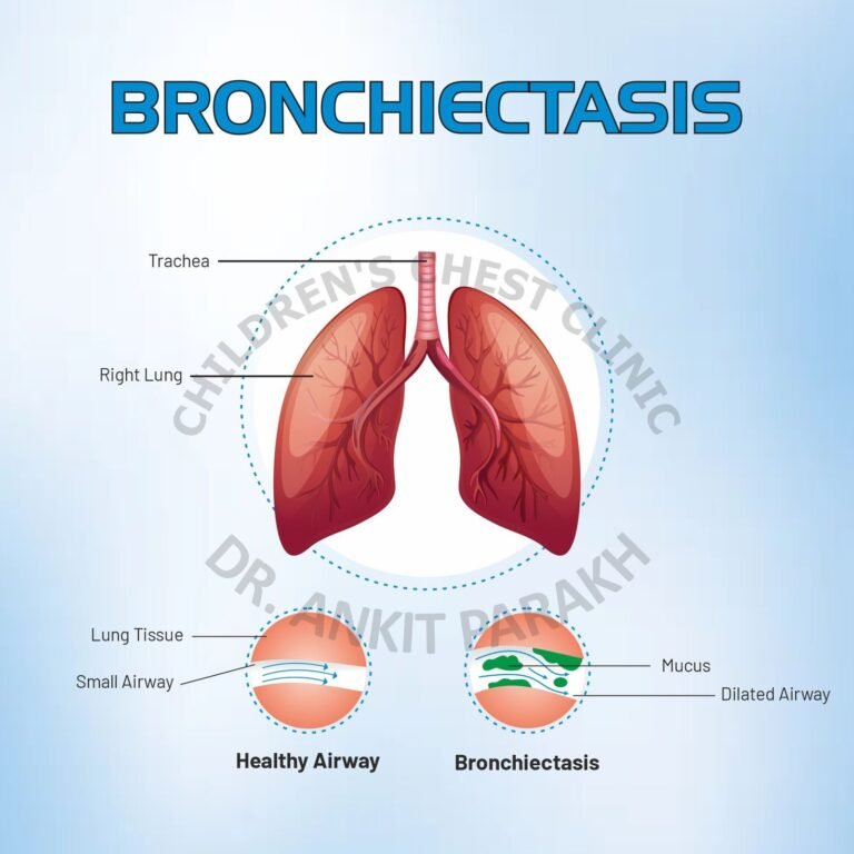 Bronchiectasis: Causes, Symptoms, and Diagnosis