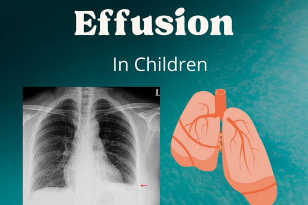Pleural effusion or Fluid inside the chest in children: causes, diagnosis & treatment