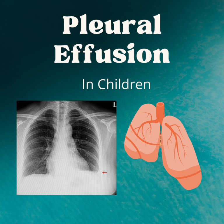 Pleural effusion or Fluid inside the chest in children: causes, diagnosis & treatment!!