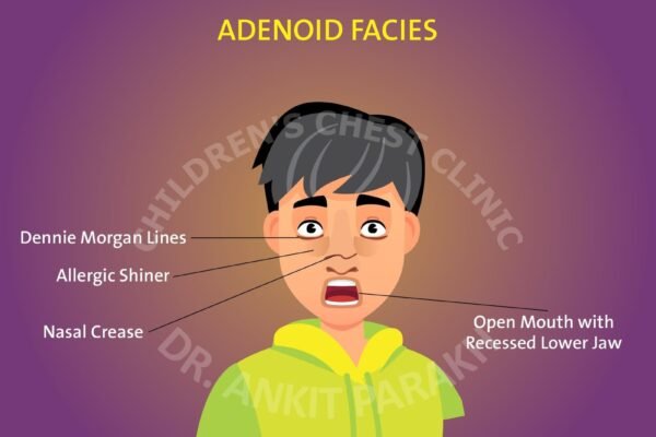 Is your child developing facial changes due to an enlarged adenoid