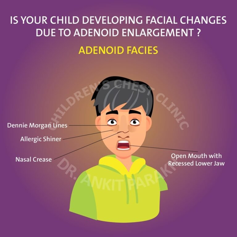 Is your child developing facial changes due to an enlarged adenoid?