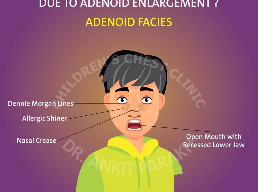 Is your child developing facial changes due to an enlarged adenoid