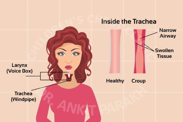 Croup in Children - Symptoms, Diagnosis and treatment