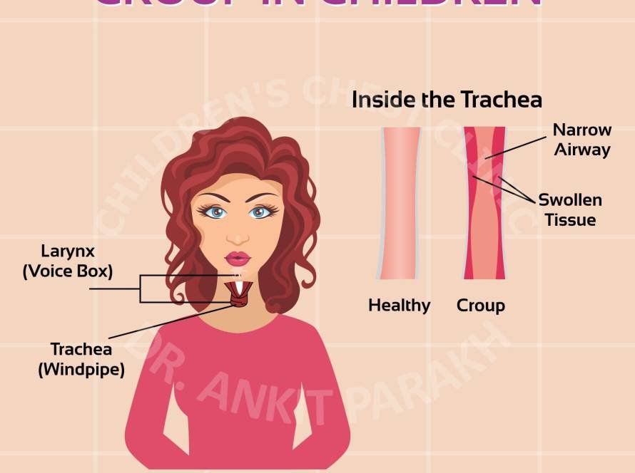 Croup in Children - Symptoms, Diagnosis and treatment