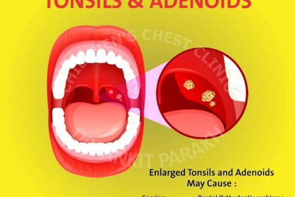 Enlarged Tonsils and Adenoids in Children: diagnosis & treatment