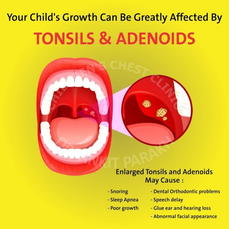 Enlarged Tonsils and Adenoids in Children: diagnosis & treatment