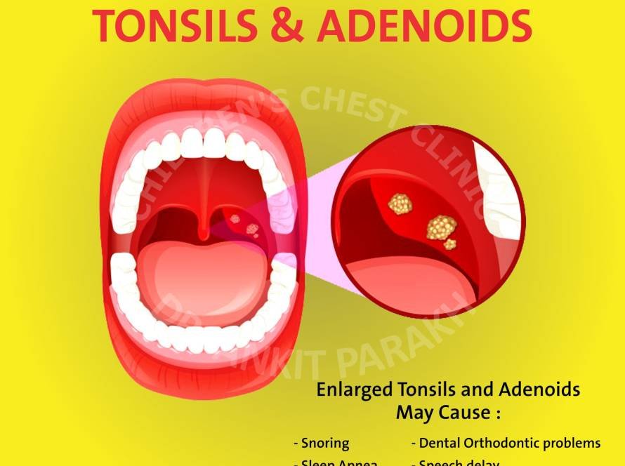 Enlarged Tonsils and Adenoids in Children: diagnosis & treatment