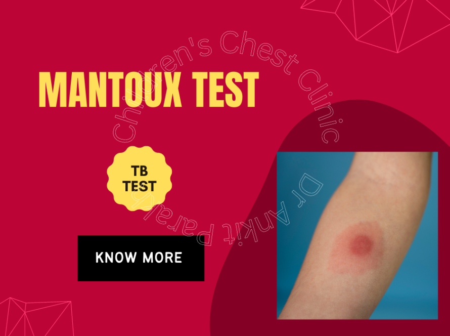 Mantoux Test or Tuberculin Skin Test