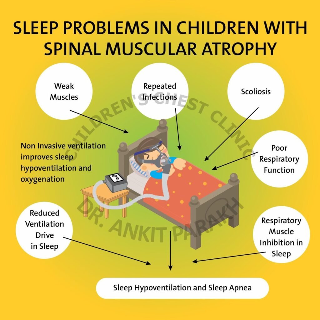 Sleep Problems in children with Spinal muscular atrophy (SMA)?