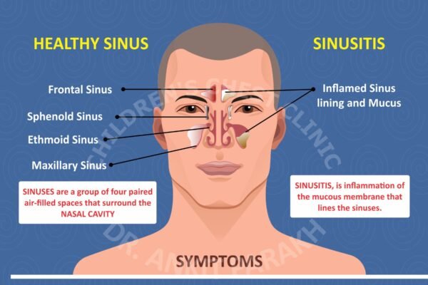 Sinusitis in Children