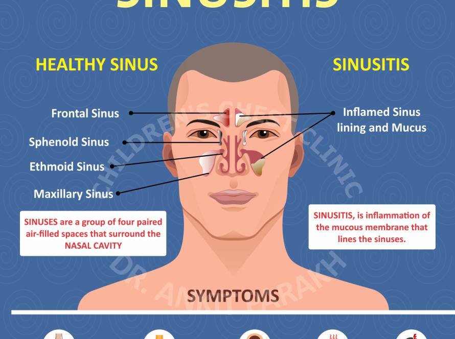 Sinusitis in Children