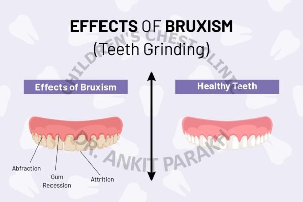 Teeth Grinding or Bruxism in Children