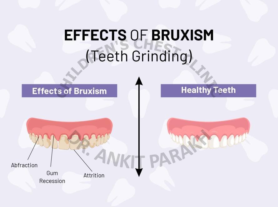 Teeth Grinding or Bruxism in Children