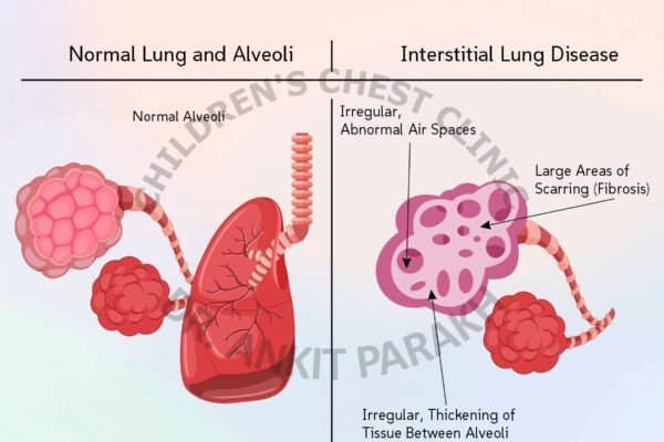 Childhood Interstitial Lung Diseases [chILD]