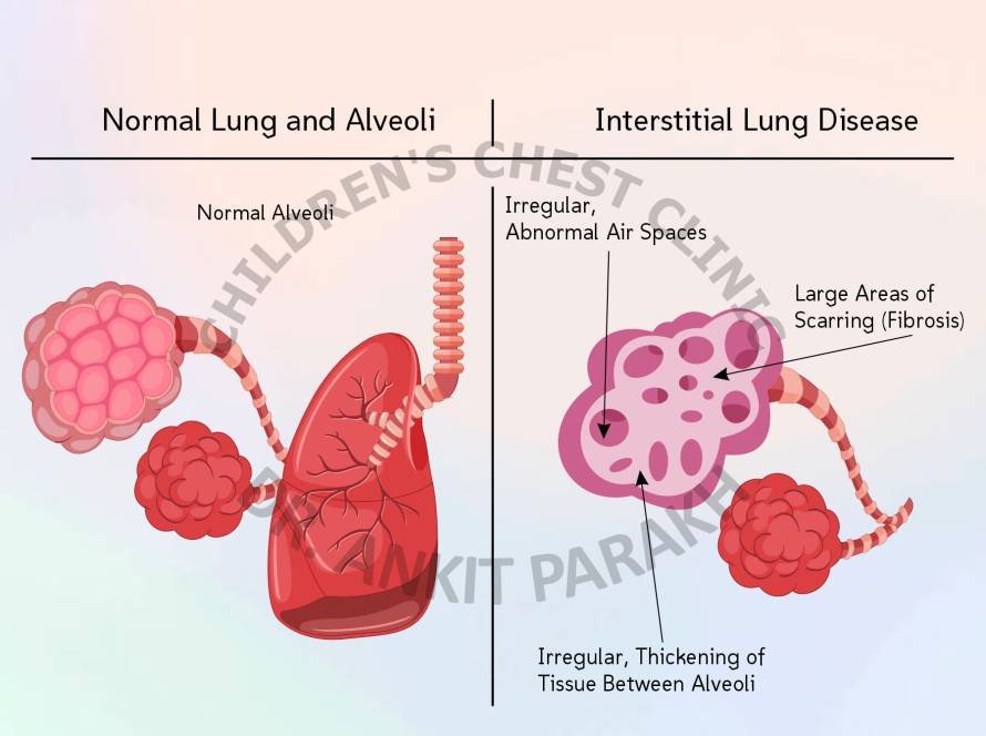 Childhood Interstitial Lung Diseases [chILD]