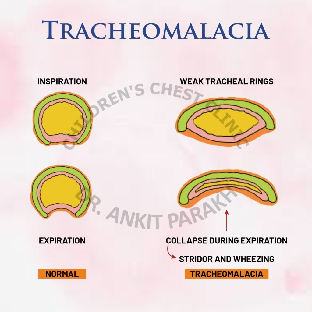 Tracheomalacia: An important cause of wheezing in young infants!