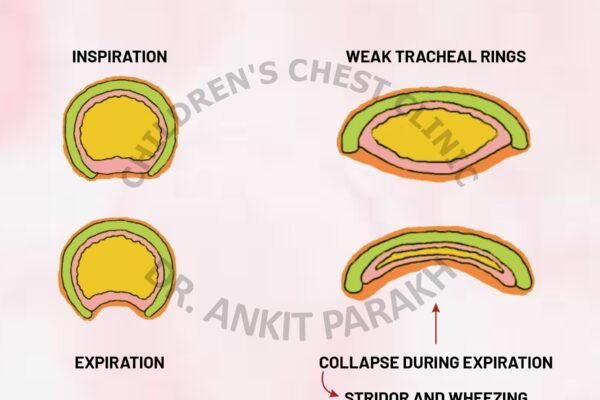 Tracheomalacia: An important cause of wheezing in young infants!